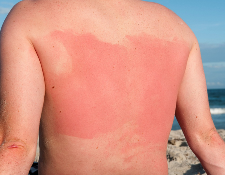 sunburnt back