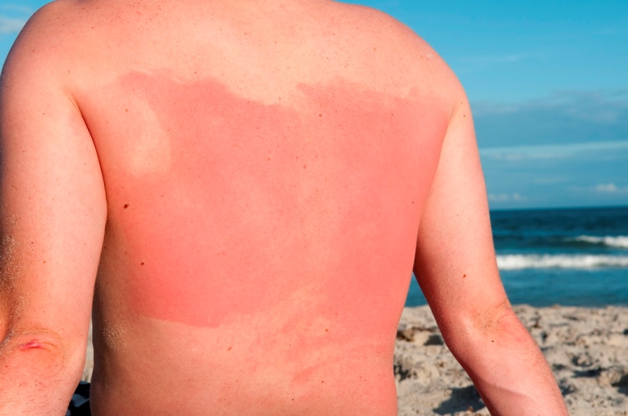 Sun Awareness Week, don’t sizzle in the sun this summer