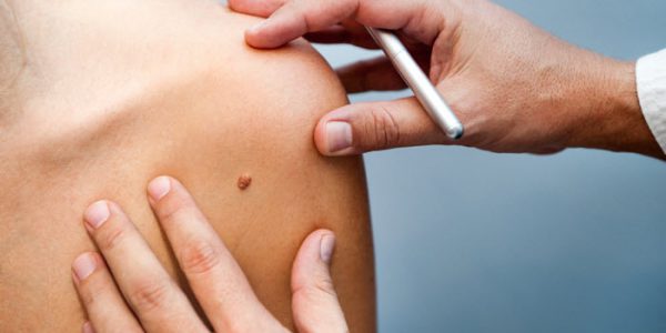 Increase in early detection of skin cancer in men